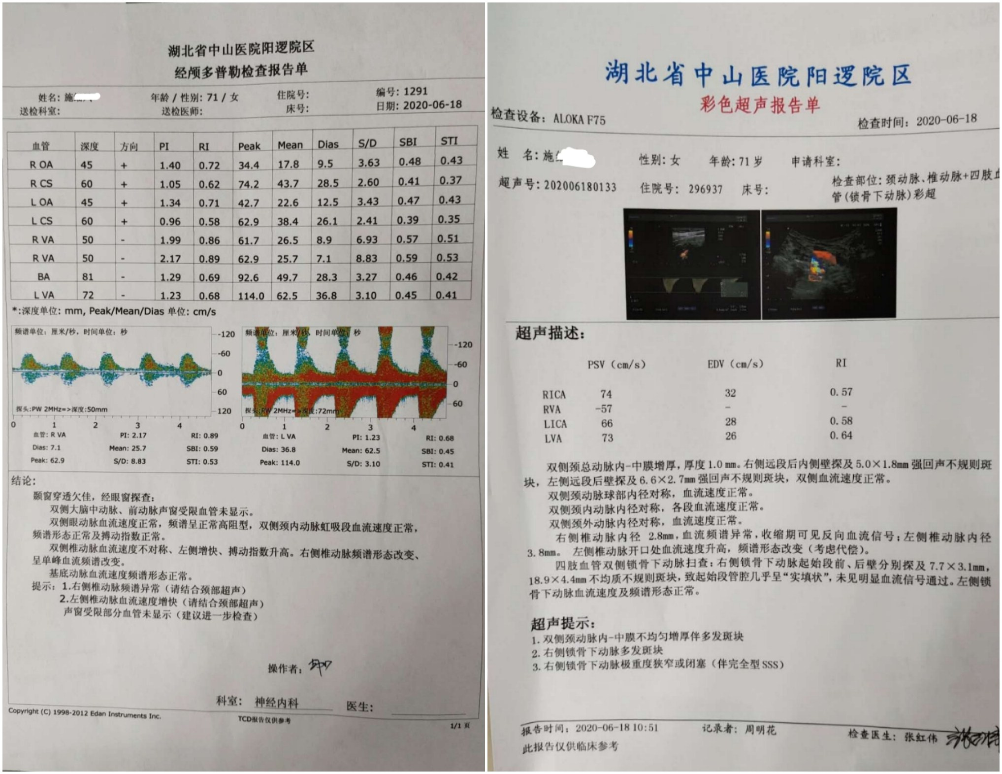 经颅多普勒超声tcd脑卒中预警利器