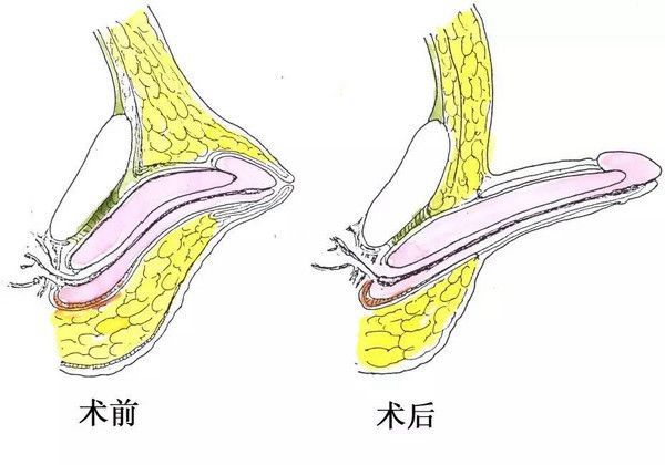 男孩小弟弟短小不发育可能是隐匿性阴茎