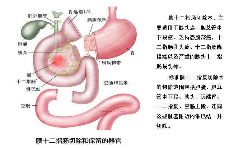 壶腹部解剖复杂特殊,壶腹周围癌是指起源于壶腹部2cm以内的范围,包括